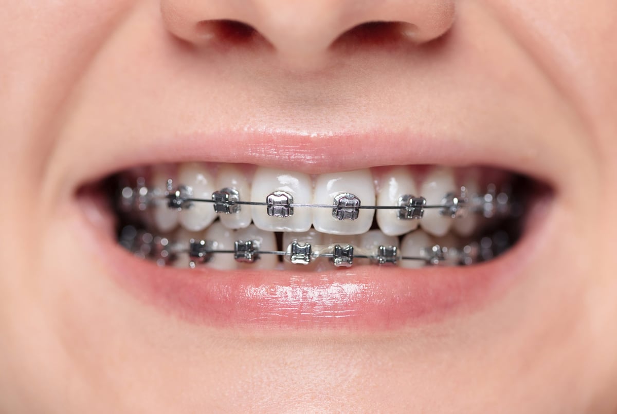 Ortodoncia brackets